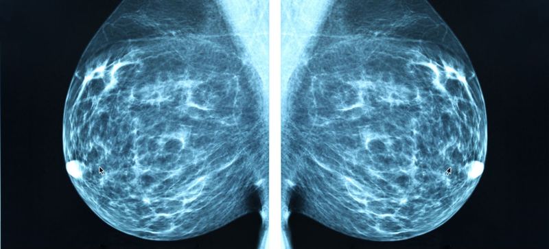Illustration for article titled Finding, Treating, and Beating the Most Survivable Forms of Cancer